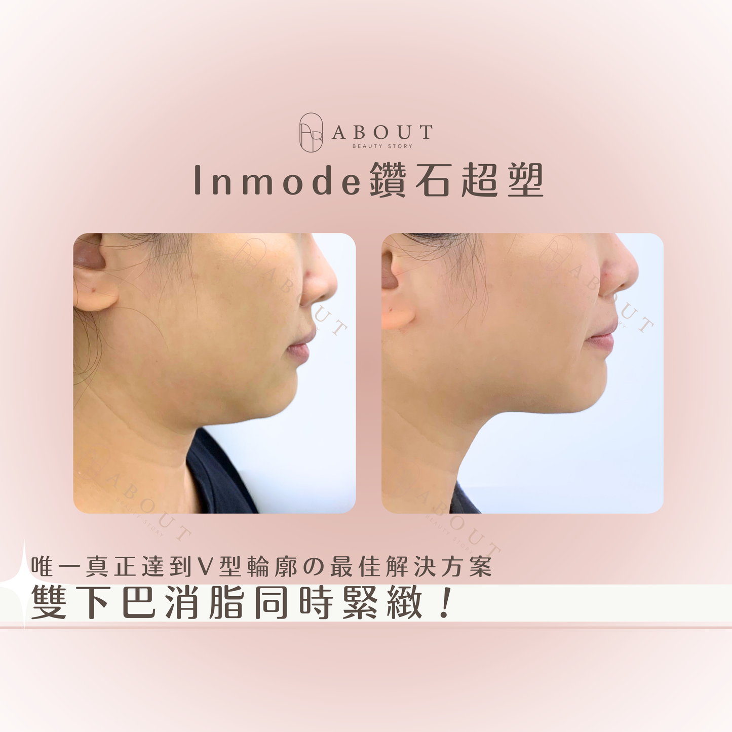 Inmode Lift 鑽石超塑