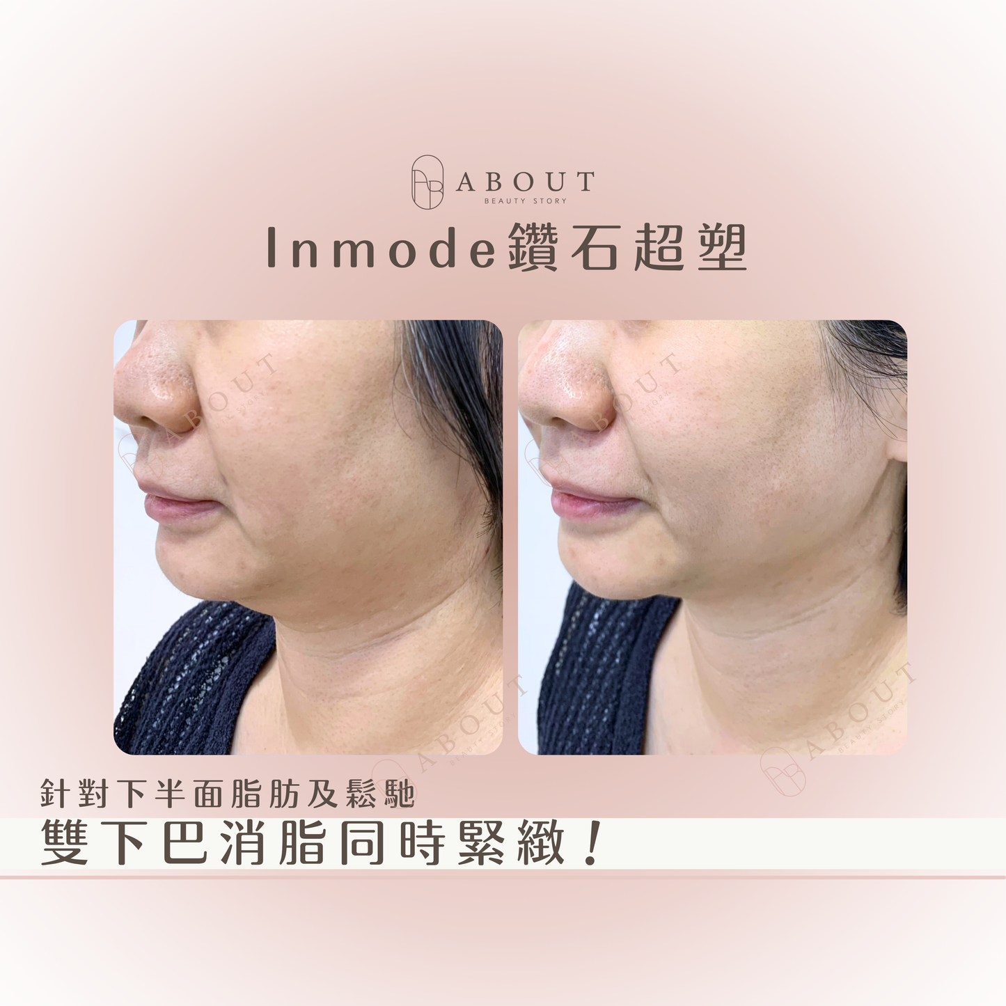 Inmode Lift 鑽石超塑