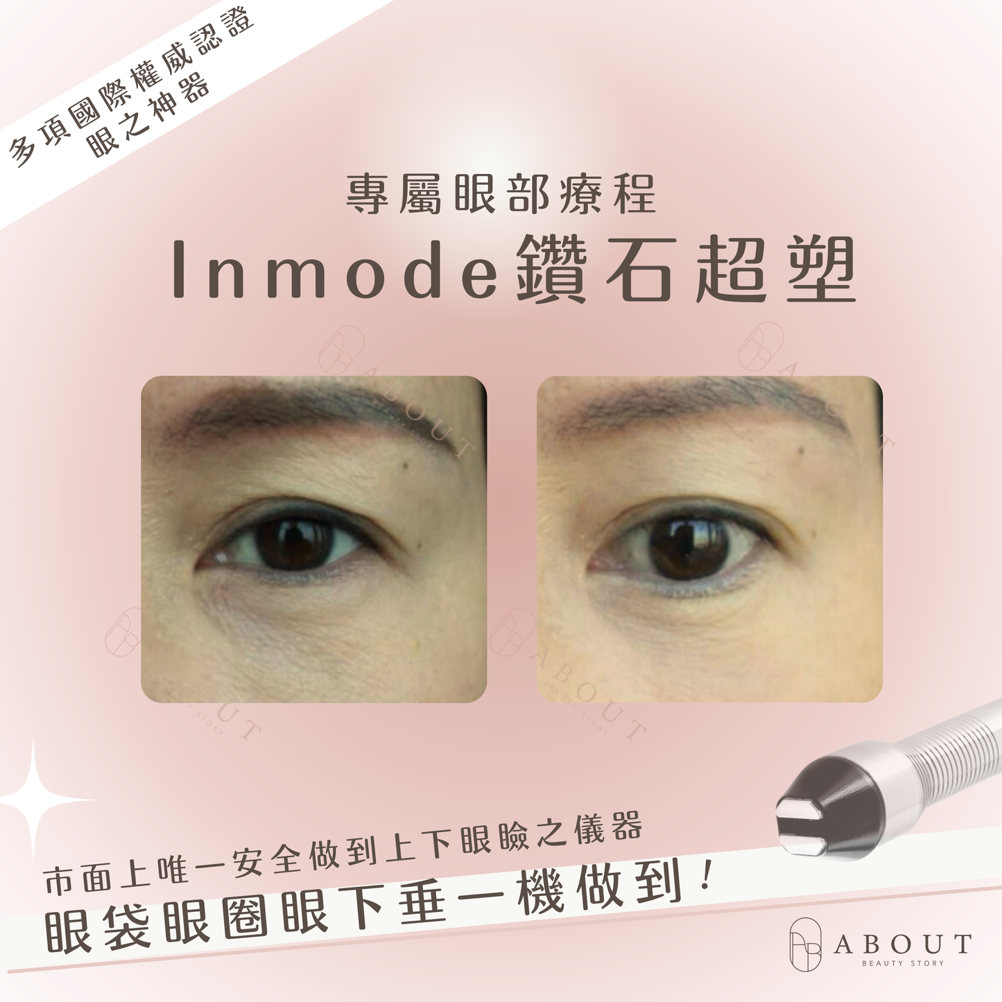Inmode鑽石超塑眼部療程