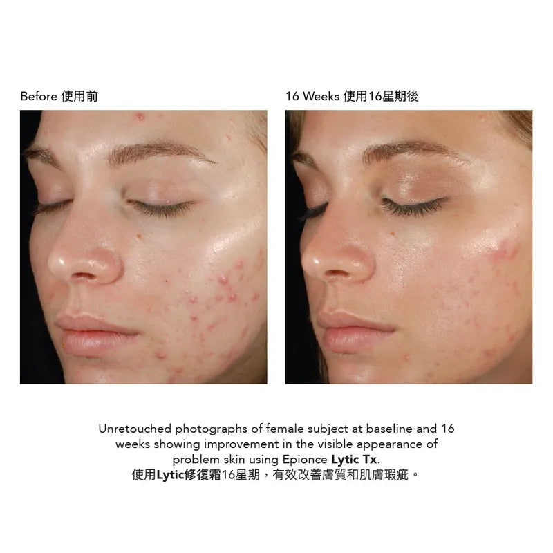 Epionce Lytic Tx 修復霜