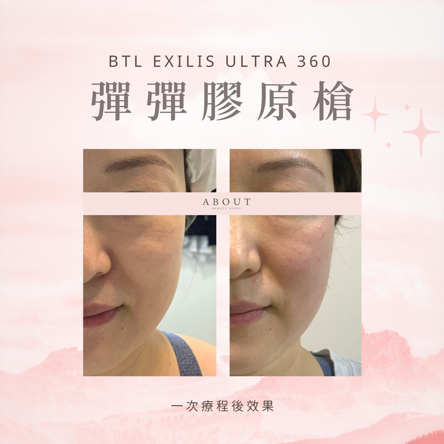 BTL 彈彈膠原槍 新客優惠碼【FACE980】