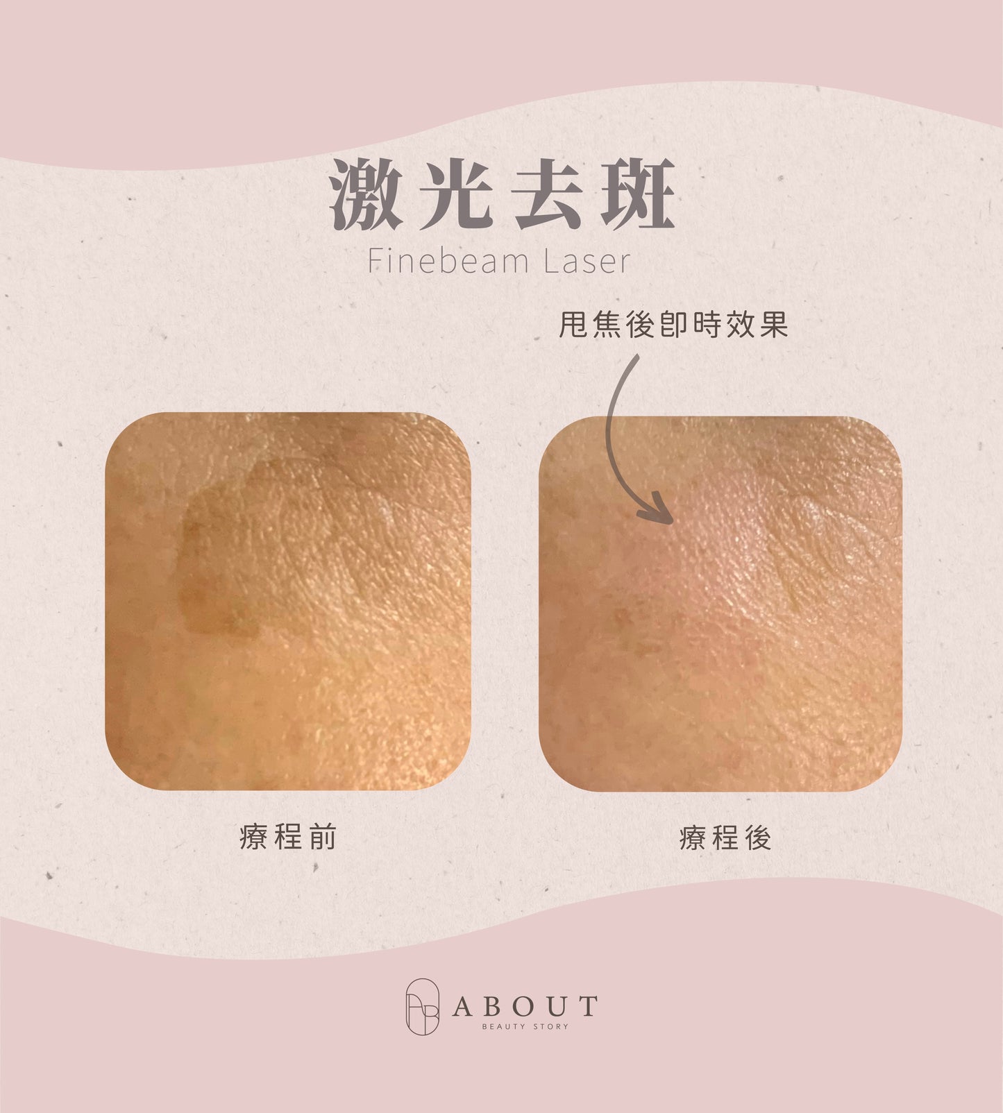 3合1 重點去斑美肌療程